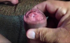 Eunuch With Penectomy Jack-off With Cum